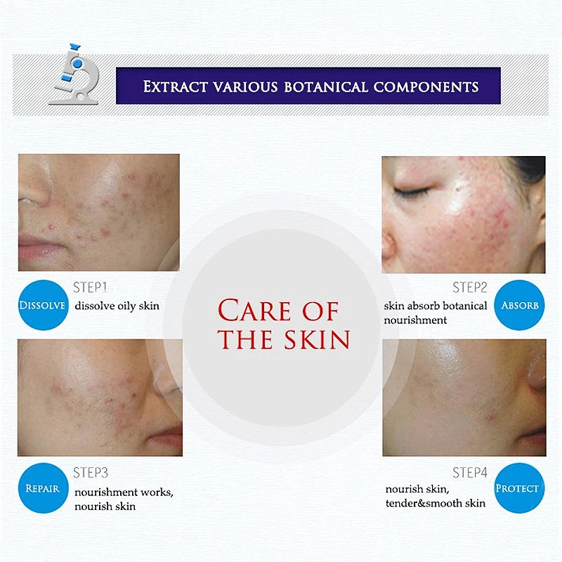 BioAqua acne cream | Bio Aqua Removal of Acne - Image 2